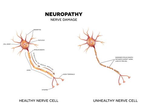 Neuropathic Painperipheral Neuropathy Pain The Orthopedic Pain