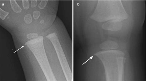 Non-accidental Trauma | Radiology Key