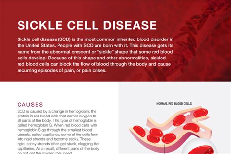 Sickle Cell Disease What Is Sickle Cell Disease Nhlbi Nih