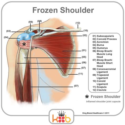 The transverse humeral ligament is not shown on this diagram. King Brand Frozen Shoulder Treatment Inflamed Joints ...