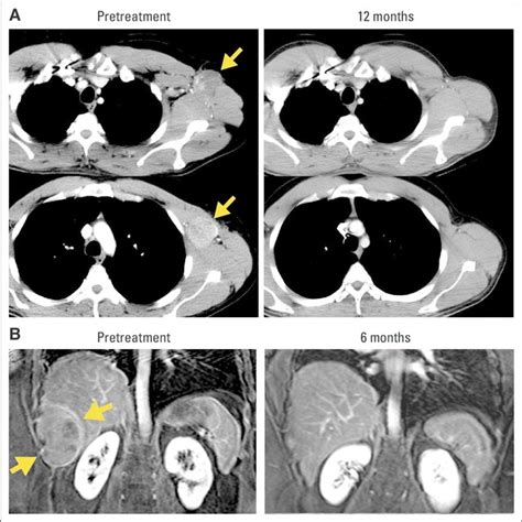 Computed Tomography Scans Demonstrating Tumor Regression Radiologic