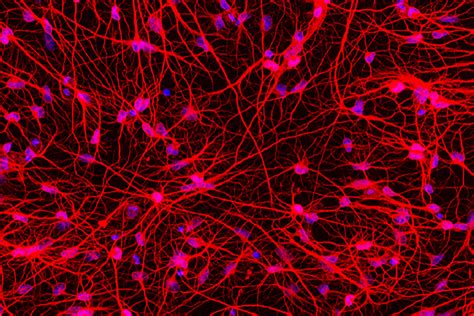 Altering Huntingtons Disease Patients Skin Cells Into Brain Cells