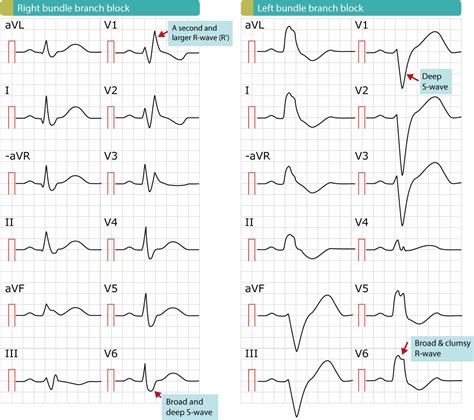 Right Bundle Branch Block RBBB ECG Criteria Definitions Causes Treatment ECG Learning