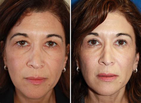 The creators of the original glycolic acid peel introduce a high performance peel that is safe and easy to with regular use, the exuviance performance peel ap25 is an ideal way to significantly reduce visible signs of aging, improve the texture of the skin, and. Chemical Peel pictures | Boston, MA | Patient 9189