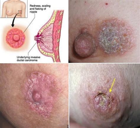 Inflammatory breast cancer pictures and symptoms What Does A Rash From Breast Cancer Look Like - Public Health