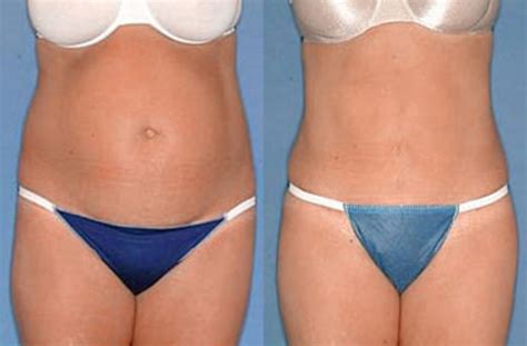 Things You Need To Know About Tummy Tuck Recovery
