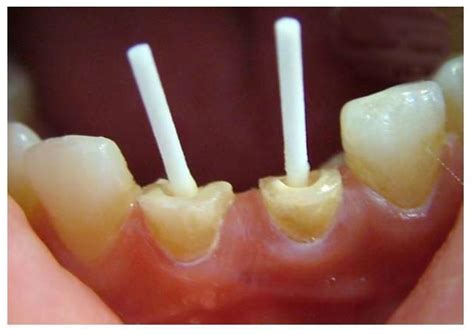 Twenty extracted teeth were randomly. Fiberglass Dental Posts Market to Witness Robust Expansion