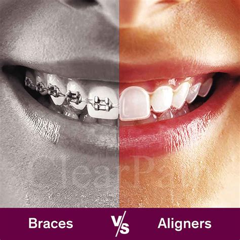 Clear Braces Costs Best Brands Pros Cons 57 Off