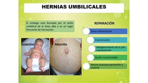 Hernias De Pared Anterolateral De Abdomen Y Lumbar