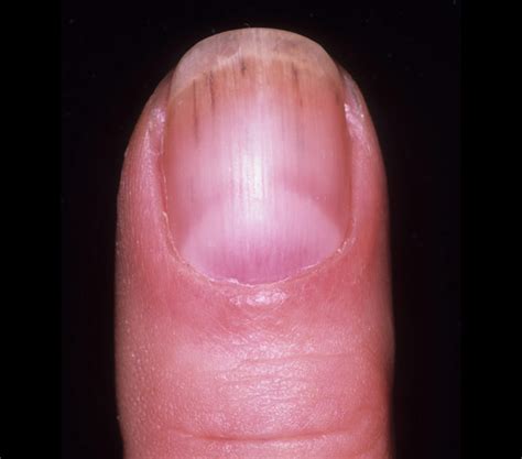 Endocarditis Nails