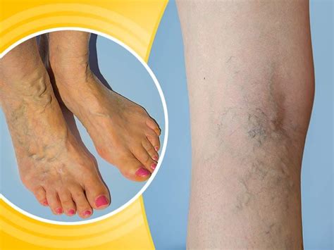 What Are The Effective Home Remedies For Varicose Veins