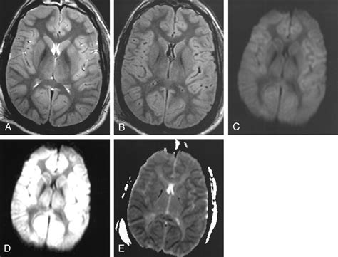 Diffusion Weighted Imaging In The Setting Of Diffuse Cortical Laminar