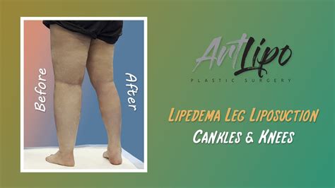 Cankles And Knees Liposuction Lipedema Legs Lipo 360° Expert Dr