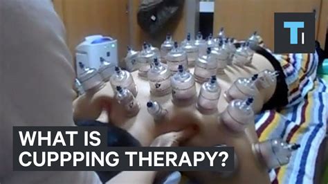 Does Cupping Really Work Videos