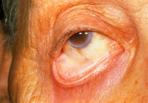 Pale Eyelid Due To Myelodysplastic Anemia Stock Image M1080420