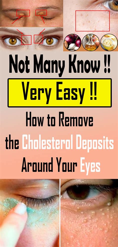 How To Remove The Cholesterol Deposits Around Your Eyes Eye Health