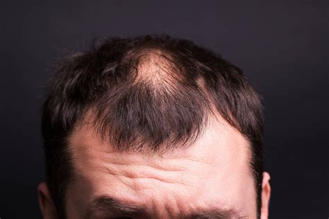 What Are The Causes And Solutions Of Thinning Hair Elithair