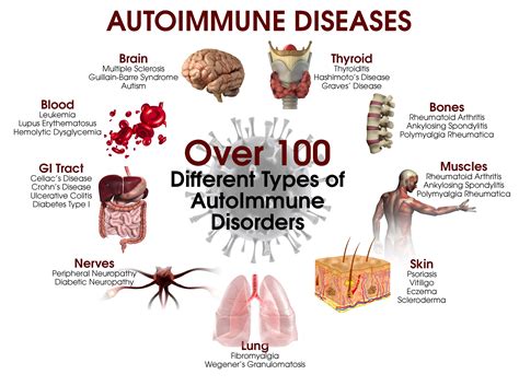 Autoimmune Elimination Program Autoimmune Disease Ulcerative Colitis