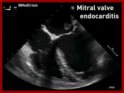 Mitral Valve Vegetation On Echocardiogram Since People Grepmed