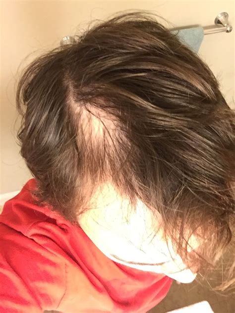 I Have A Weird Bald Spot Along My Hairline Anything I Can Do To Fix