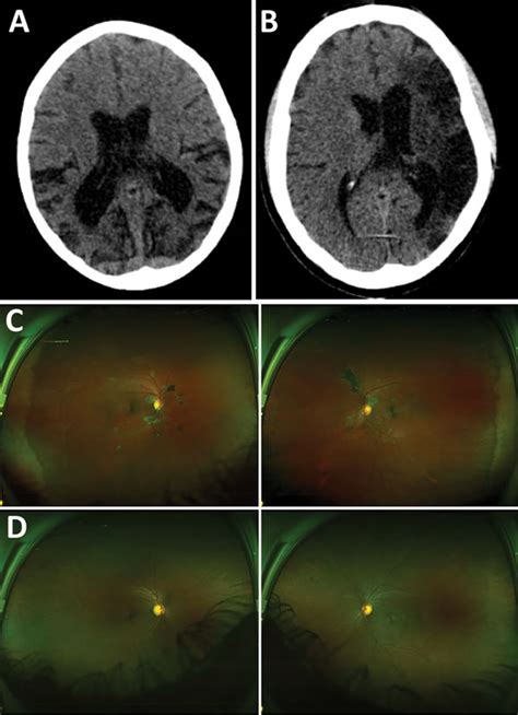 Ebola 2 is created in the spirit of the great classics of survival horrors. Figure 3 - Case Series of Severe Neurologic Sequelae of Ebola Virus Disease during Epidemic ...