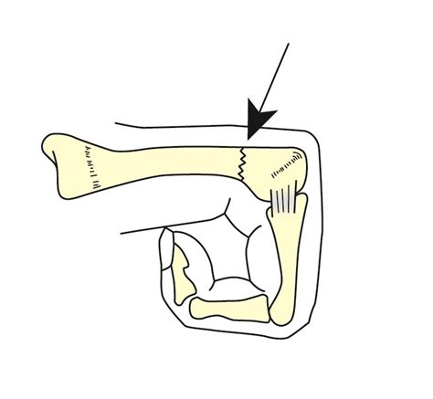 boxer s fracture｜zamst