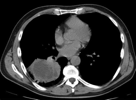 High Grade Primary Pulmonary B Cell Lymphoma Presenting As A Necrotic