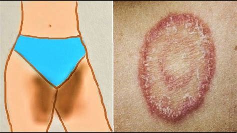 How To Treat Private Part Itching Fungal Infection Burning Yeast Infection Home Remedies
