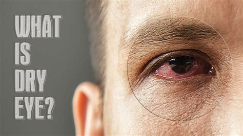 The Causes Of Dry Eye Syndrome When To Visit The Doctor
