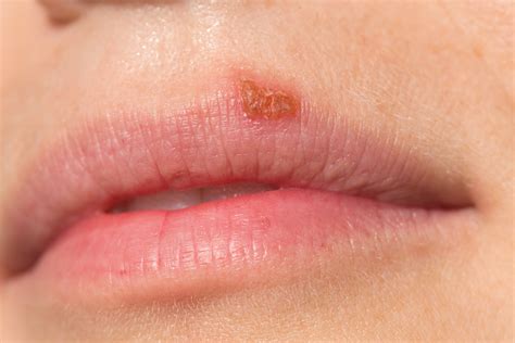 Lip Herpes The Art Of Beauty