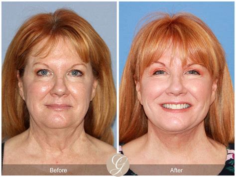 Eyelid Lift Before And After Photos From Dr Kevin Sadati