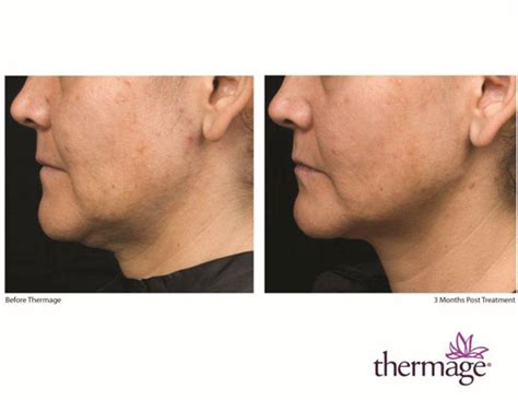 Thermage® Nyc New York Michele S Green Md