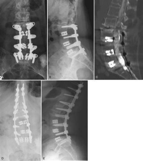 Revision Spine Surgery Clinical Gate