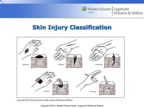 Ppt Chapter 4 Injury Mechanism And Classification Of Injury
