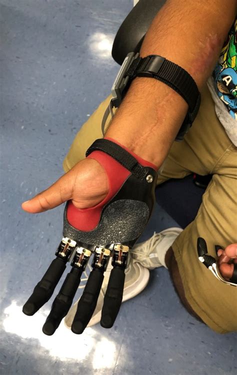 Hand And Finger Prosthetics Mcop