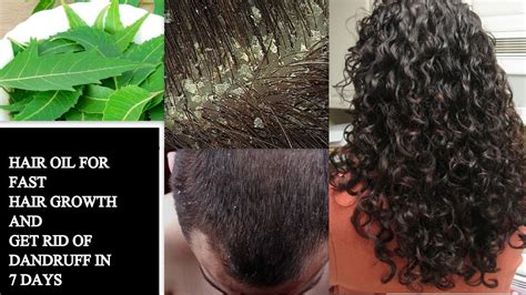 How to get rid of dandruff in dreads. Best home remedy to get rid of dandruff in Tamil - YouTube