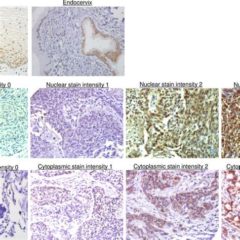 Gs28 Immunohistochemical Staining In The Cervix A In Normal Cervical