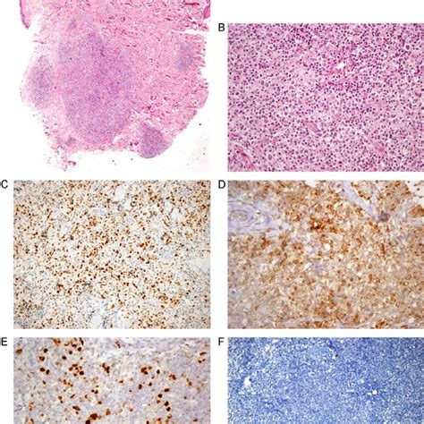 A Case Of Primary Cutaneous Follicle Center Lymphoma Presented As A