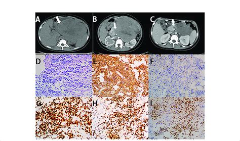 Imaging Finding And Histology Of Primary Pancreatic Burkitt Lymphoma