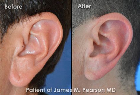 Photos Before And After Earlobe Plastic Surgery Dr James Pearson