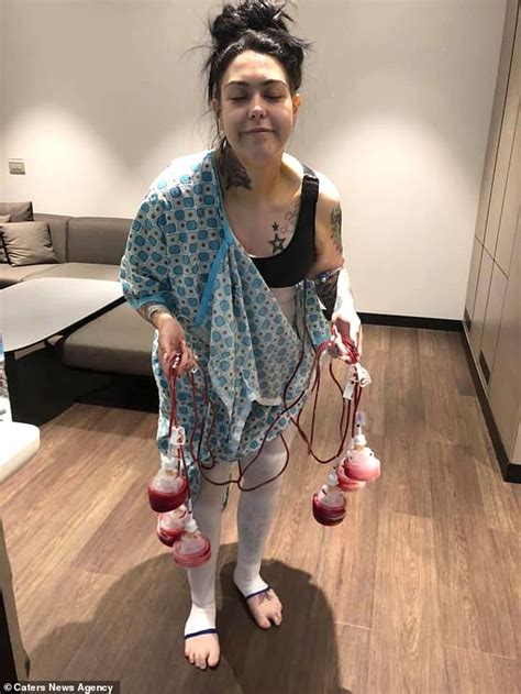 Woman Is Left Flat Chested Following Botched Surgery In Turkey Express Digest