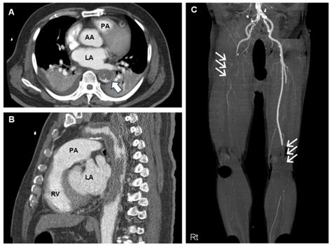 Concealed Primary Aortic Sarcoma Induced Hypertensive Encephalopathy