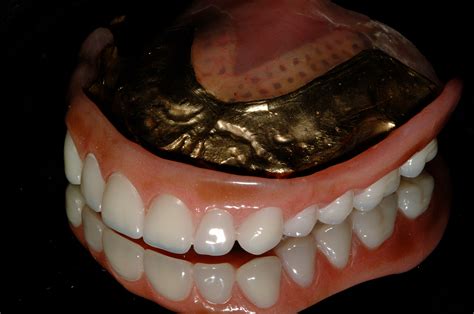 Implant Overdenture Seattle Implant And Prosthetic Dentist