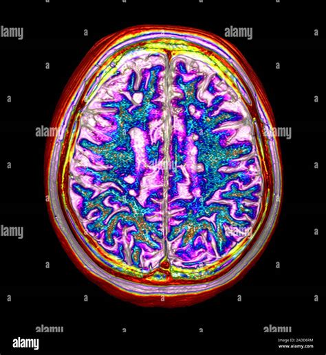 Multiple Sclerosis Coloured Axial Magnetic Resonance Imaging Mri Scan Through The Upper