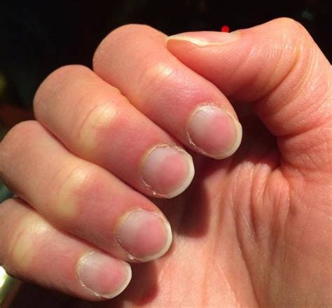 Алмазов в.а., журавлев в.а., наймарк д.а., петров м.н. Nail abnormalities: Causes, symptoms, and pictures