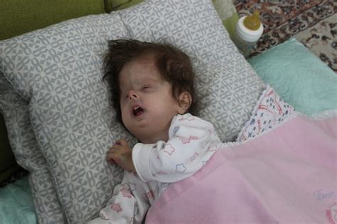 There are fewer than 200 people with the syndrome worldwide. 2 yaşında ama 3 aylık bebek gibi - Yaşam Haberleri ...