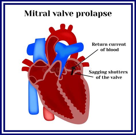 Heart Structure Mitral Valve Prolapse Stock Vector Illustration Of