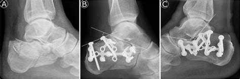 A Lateral Preoperative Radiograph Of A Sanders Type 3ac Calcaneal