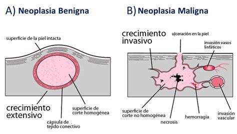 ¿qué Es Un Tumor Benigno Curiosoando