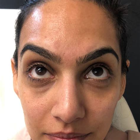 Redensity Ii Under Eye Treatment Before And After Photos Md Beauty Clinic